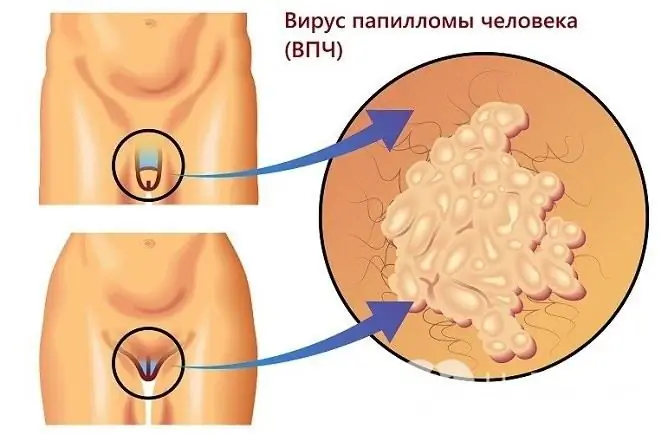 Anogenital warts, or condylomas, are caused by the human papillomavirus