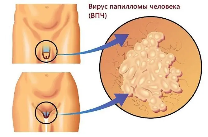 Genital Warts: Photo, Treatment, Causes Of Appearance