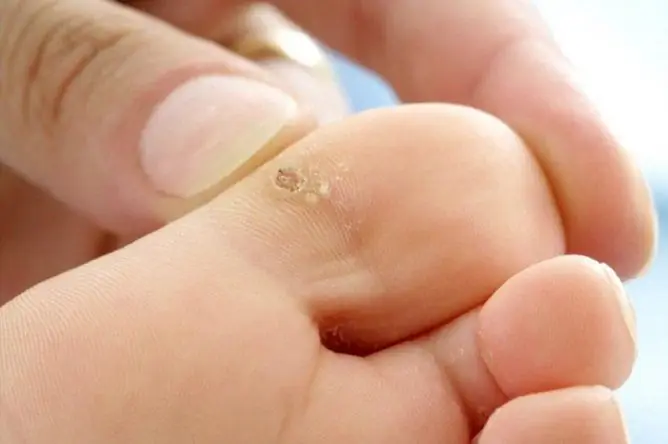 Wart On The Toe: Photos, Reasons, How To Get Rid Of At Home