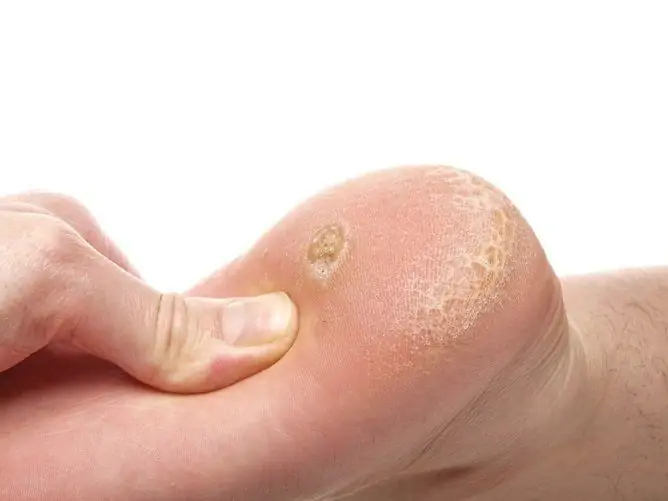 Wart On The Heel: Photo, How To Get Rid Of At Home, Reasons