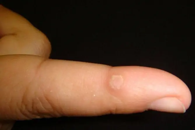 Wart On A Finger: How To Get Rid Of It At Home, Photo