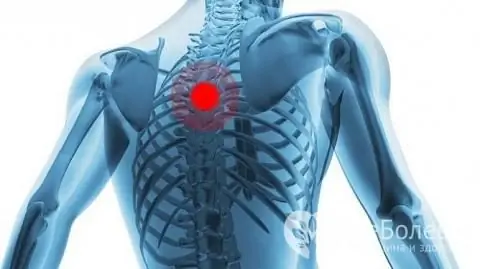 Die Behandlung der Brustosteochondrose zu Hause sollte unter Aufsicht eines Arztes durchgeführt werden. Eine Selbstmedikation ist nicht akzeptabel