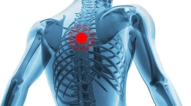 Leczenie Osteochondrozy Klatki Piersiowej W Domu: Metody, Wideo