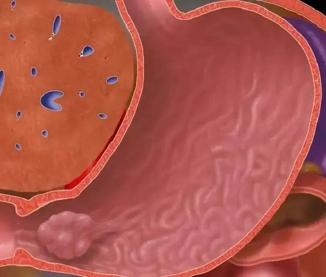 Polyps I Magen: Symptomer, Behandling, Hvor Farlig, årsaker