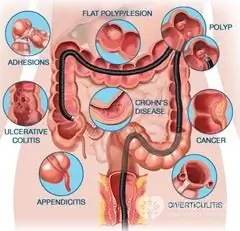 Colonoscopy of the intestine