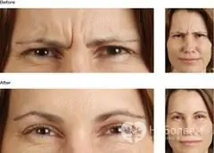 What are the differences between botox and dysport