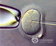 Como vai a gravidez após a fertilização in vitro