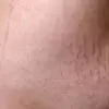 Stretch Mark Pada Kulit - Apa Yang Harus Dilakukan?