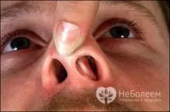 Mengapa kelengkungan septum hidung berbahaya?