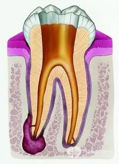 What is a cyst on the cornet of a tooth