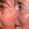 Pourquoi Le Peeling Au Laser Est-il Bon