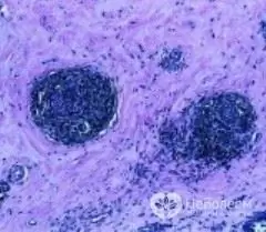 Correction of hormonal levels - the basis for the treatment of fibrous mastopathy