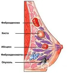 Treatment of fibrous mastopathy