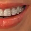 Malocclusion: Kdy A Jak By Se S Ním Mělo Zacházet?