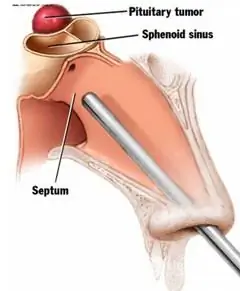 Computertomografie van hypofyse-adenoom