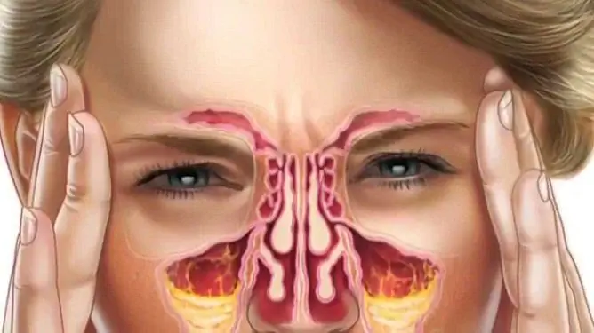 Cara Menyembuhkan Sinusitis Di Rumah Dengan Cepat Dan Tanpa Tusukan: Kaedah