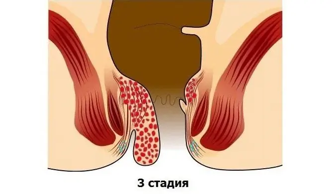 Hemorojus 3 Laipsniai: Gydymas Be Operacijos Namuose, Metodai