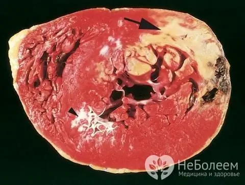 Myocardial infarction threatens the patient's life, and therefore requires immediate medical attention