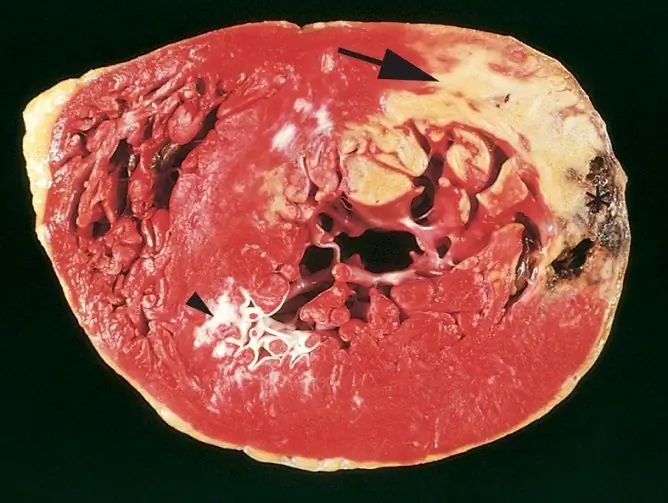 Обширен инфаркт: какво е това, последици, симптоми, причини