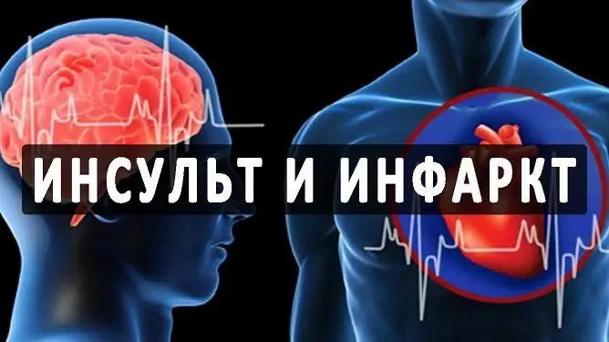 Care Este Diferența Dintre Un Accident Vascular Cerebral și Infarctul Miocardic: Care Este Diferența, Care Este Mai Periculoasă