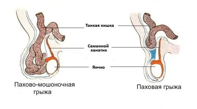 Inguinal-scotal Tyrä: Oireet, Hoito, Leikkaus, Komplikaatiot, Valokuvat