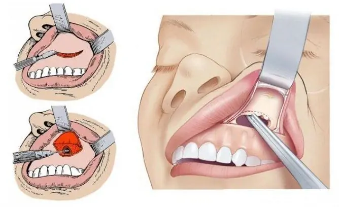 Removal Of The Cyst Of The Maxillary Sinus: Types Of Operations And Their Features