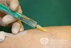 Vein sclerotherapy procedure