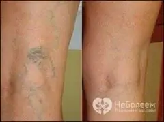 Painless vein sclerotherapy procedure