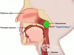 Treatment of adenoids in children according to Strelnikova