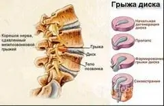 Spinální kýla: metody léčby