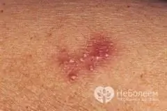 Herpes under graviditeten