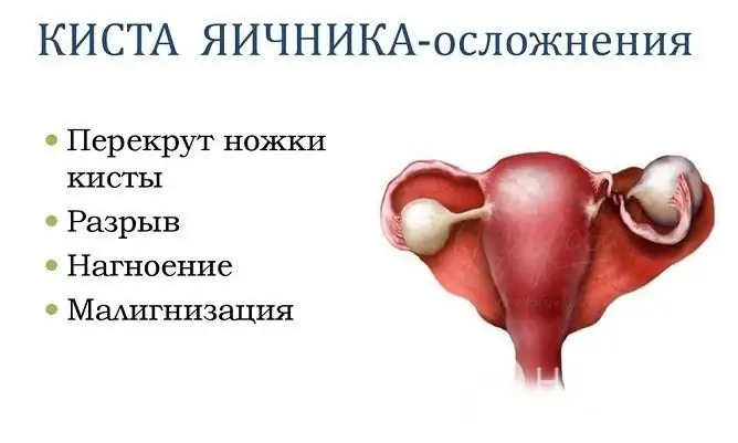 Chisturile ovariene de retenție trebuie, de obicei, îndepărtate chirurgical numai dacă apar complicații