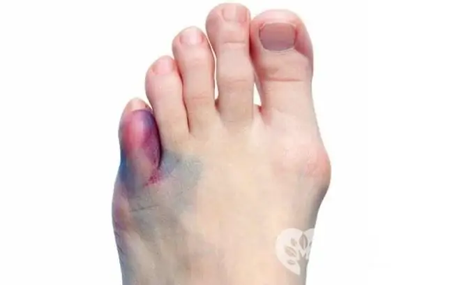 In uncomplicated cases, a bruise can be distinguished from a fracture by the characteristic features of these injuries