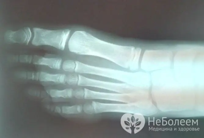 X-ray kaki biasanya mencukupi untuk mengesahkan diagnosis