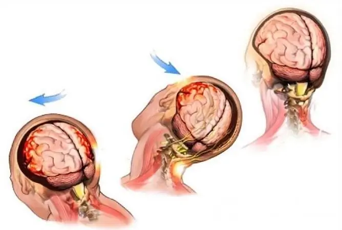 The shape and severity of the hemorrhage depends on many factors, including the direction of the blow