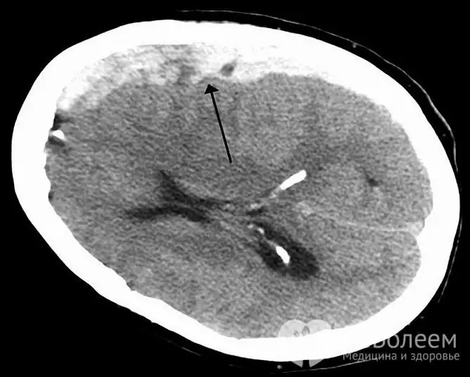 Diagnosis disahkan oleh tomografi yang dikira