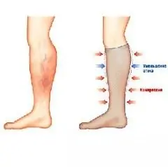 Les bas de compression pour varices soutiennent les parois veineuses