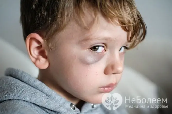 Hematomas visbiežāk izraisa trauma