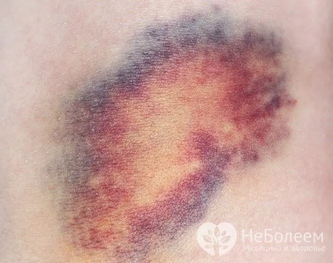 Hematoma subkutan dicirikan oleh kelembutan, pembengkakan dan perubahan warna kawasan kecederaan