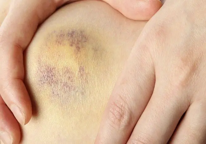 Bruises On The Body For No Reason In Women And Men: Why They Appear On The Arms And Legs