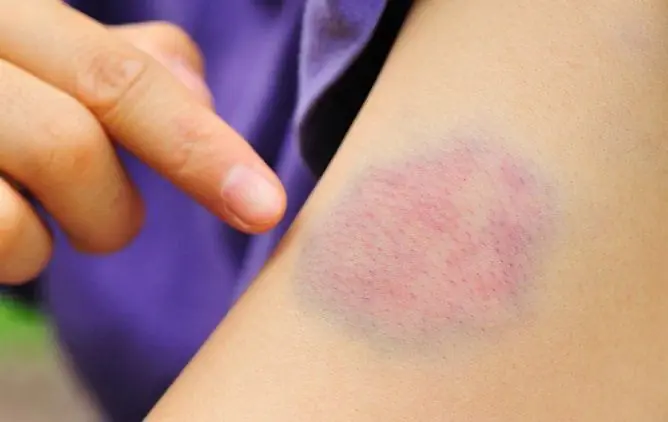 Folk Remedies For Bruises, Hematomas And Bruises: The Most Effective