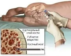 The principle of bone marrow transplantation