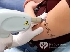 Îndepărtarea tatuajelor