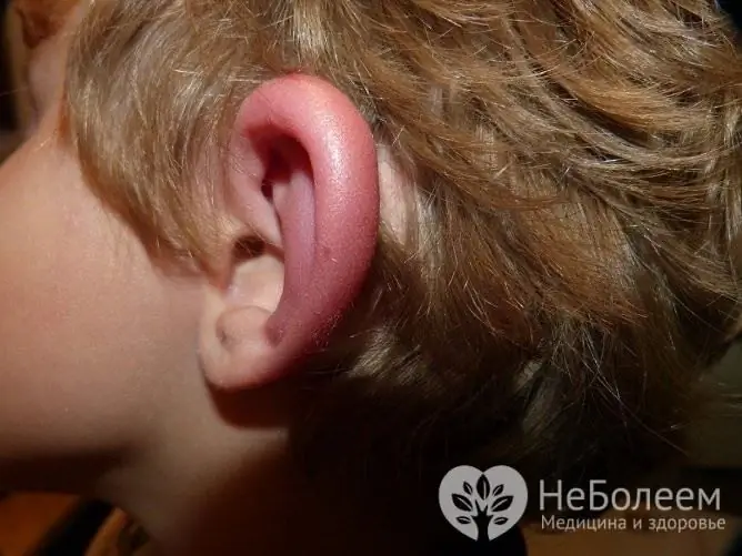 L'œdème de l'oreille externe est le plus souvent causé par des blessures ou des allergies