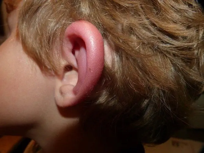 Œdème De L'oreille: Causes, Traitement, Comment Soulager L'œdème à La Maison