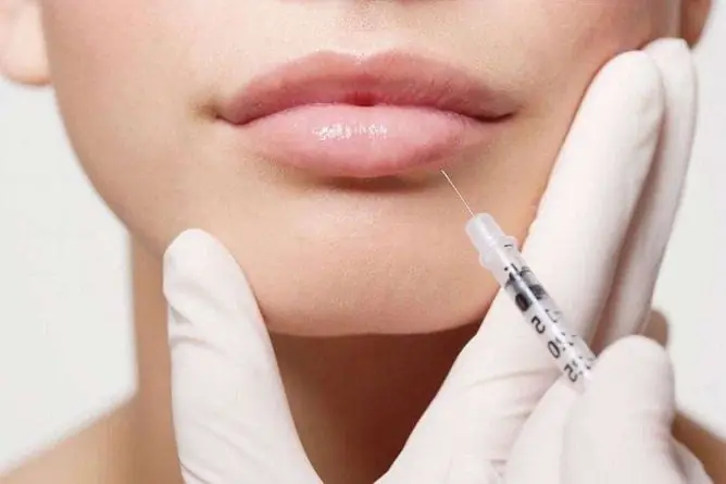 Schwellung Nach Lippenvergrößerung Mit Hyaluronsäure: Wie Lange Dauert Es Und Wie Wird Es Entfernt?