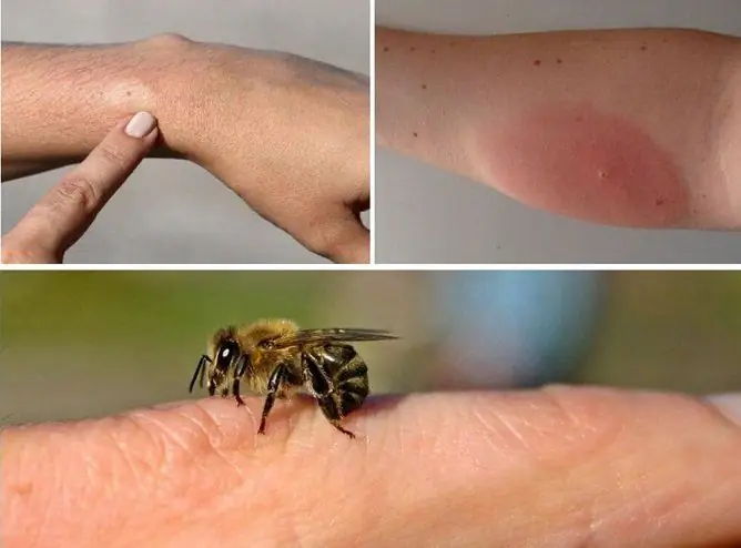 How To Relieve Swelling From A Bee Sting At Home