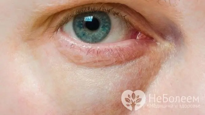 Puffy bags under the eyes can be caused by kidney disease