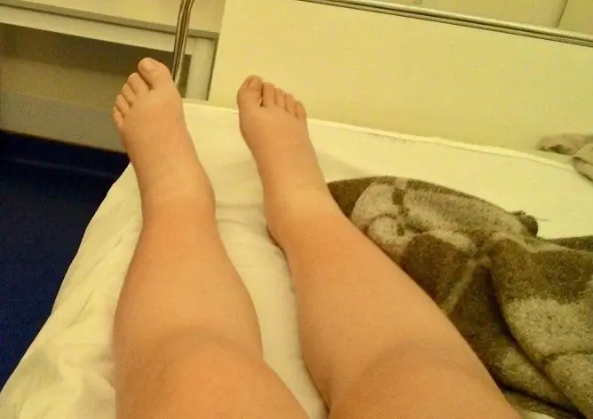 Gonflement Des Jambes Après Une Césarienne: Causes, Traitement, Combien De Jours Cela Prend