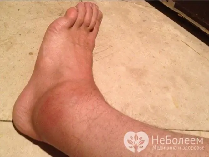 Swelling of the ankle and foot is often traumatic